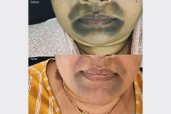 best treatment for hyperpigmentation