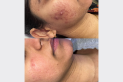 Glow Peel + Green Peel