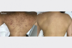 Glow Peel + Microdermabrasion