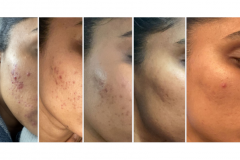 HydraFacial   Microneedling Progress  Pictures