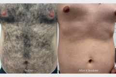 Laser Hair Removal (Men)