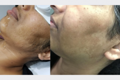 Laser Hair Removal (Women)