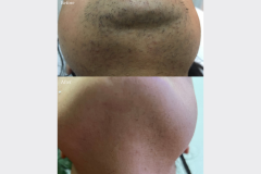 laser hair removal deals brampton