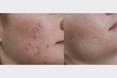 Microdermabrasion