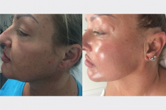 Microneedling & Green Peel