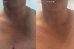 Microneedling & Photofacial