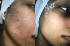 Microneedling