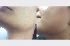 Oxygeneo + Microdermabrasion