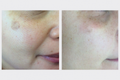 Pixel Laser Resurfacing - launique