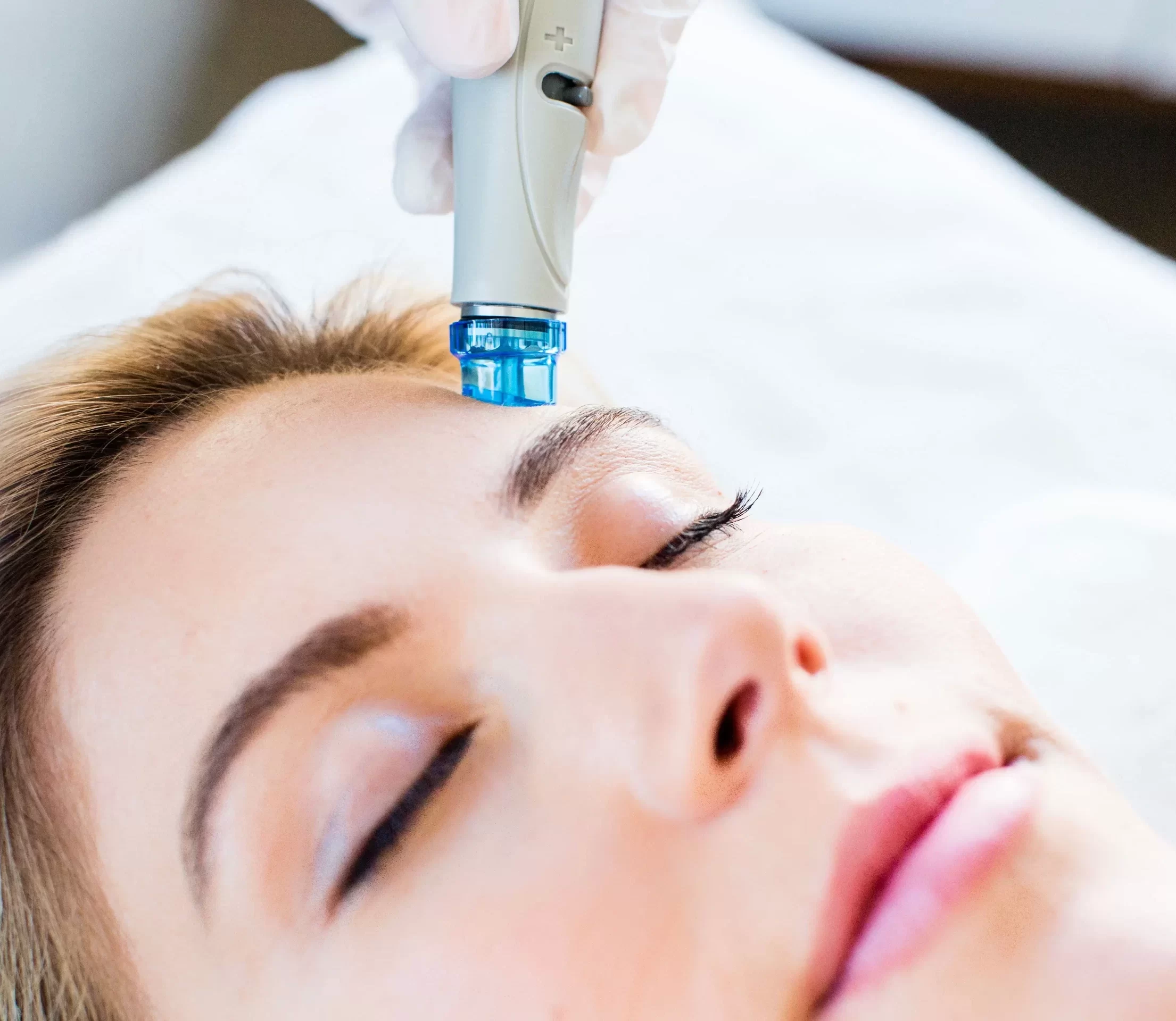 HydraFacial blemish appearance result