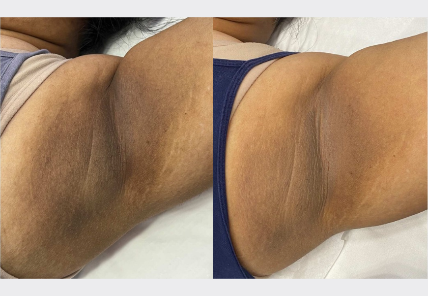 ClearLift treatment for underarm pigmentation and uneven skin tone